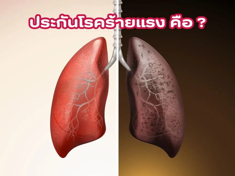 ประกันโรคร้ายแรง คืออะไร 2025